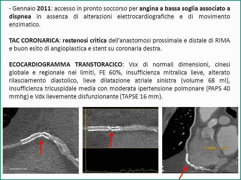 Insufficienza Tricuspidale Lieve E Cardiopatia ischemica Cronica Ppt Video Online Scaricare